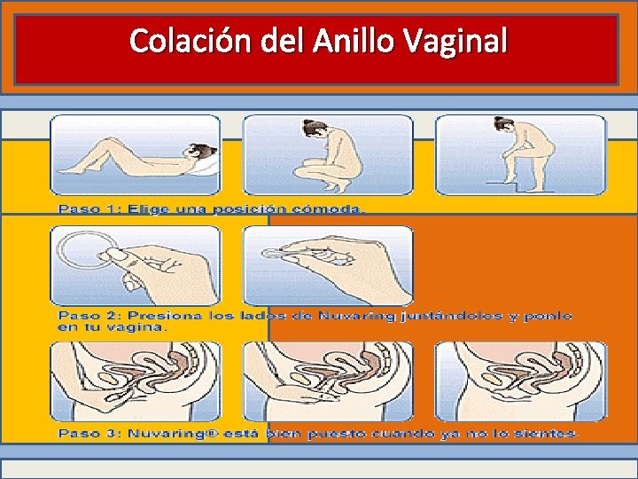 Colación del Anillo Vaginal 