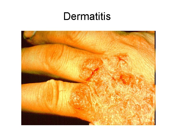 Dermatitis 