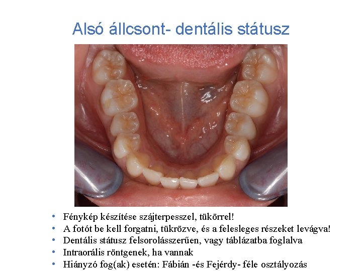 Alsó állcsont- dentális státusz • • • Fénykép készítése szájterpesszel, tükörrel! A fotót be