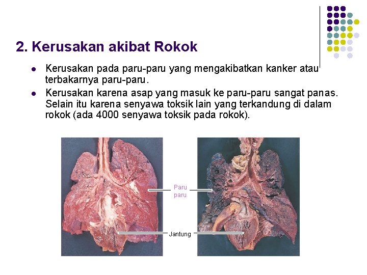 2. Kerusakan akibat Rokok l l Kerusakan pada paru-paru yang mengakibatkan kanker atau terbakarnya