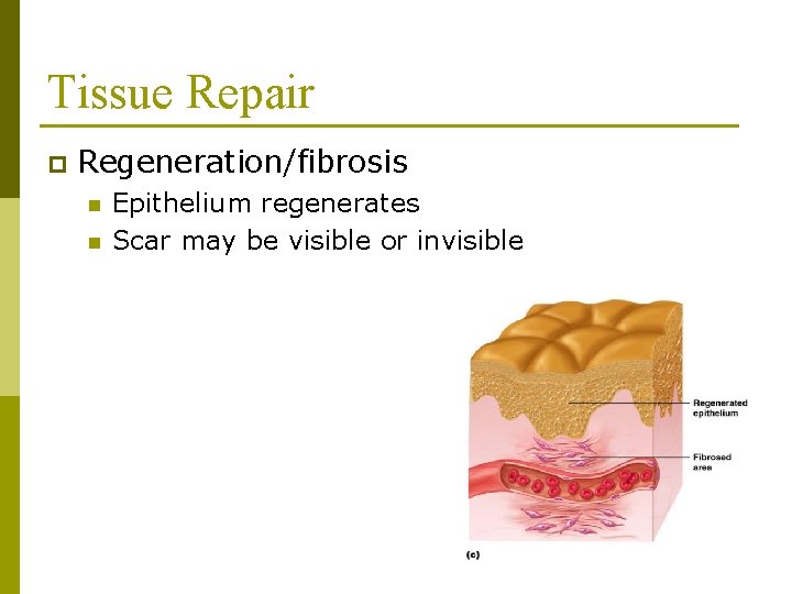 Tissue Repair p Regeneration/fibrosis n n Epithelium regenerates Scar may be visible or invisible