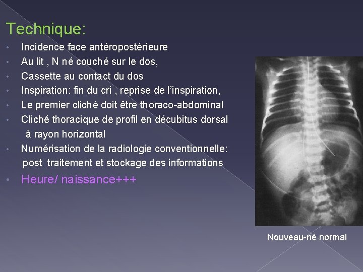 Technique: • • Incidence face antéropostérieure Au lit , N né couché sur le