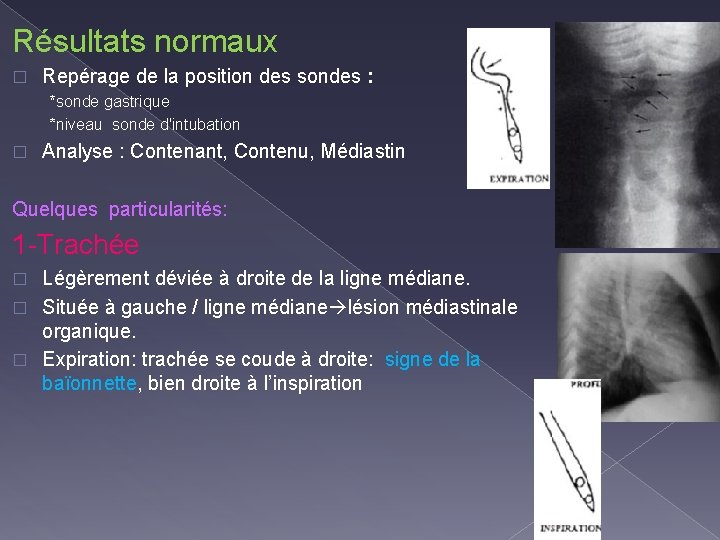 Résultats normaux � Repérage de la position des sondes : *sonde gastrique *niveau sonde