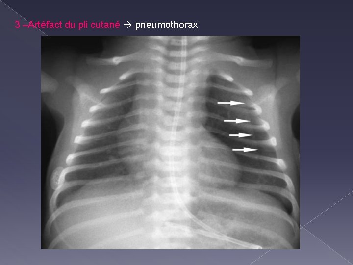 3 –Artéfact du pli cutané pneumothorax 