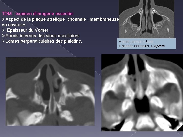 TDM : examen d'imagerie essentiel ØAspect de la plaque atrétique choanale : membraneuse ou
