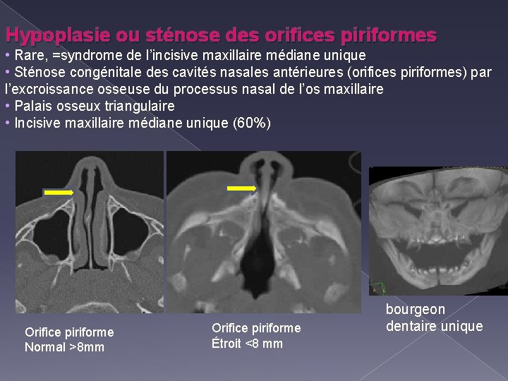 Hypoplasie ou sténose des orifices piriformes • Rare, =syndrome de l’incisive maxillaire médiane unique