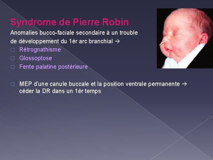 Syndrome de Pierre Robin Anomalies bucco-faciale secondaire à un trouble de développement du 1èr