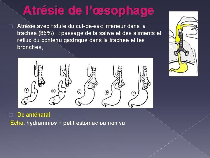 Atrésie de l’œsophage � Atrésie avec fistule du cul-de-sac inférieur dans la trachée (85%)