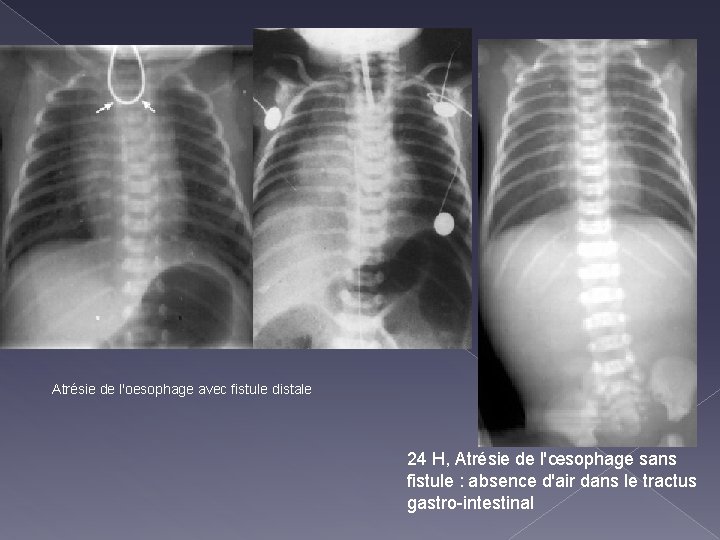 Atrésie de l'oesophage avec fistule distale 24 H, Atrésie de l'œsophage sans fistule :