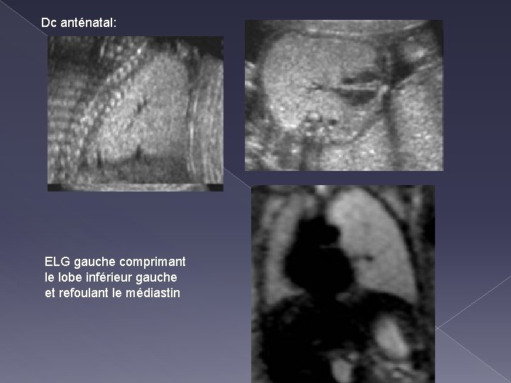 Dc anténatal: ELG gauche comprimant le lobe inférieur gauche et refoulant le médiastin 