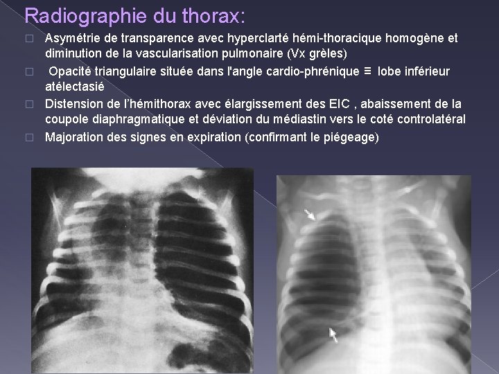 Radiographie du thorax: Asymétrie de transparence avec hyperclarté hémi-thoracique homogène et diminution de la