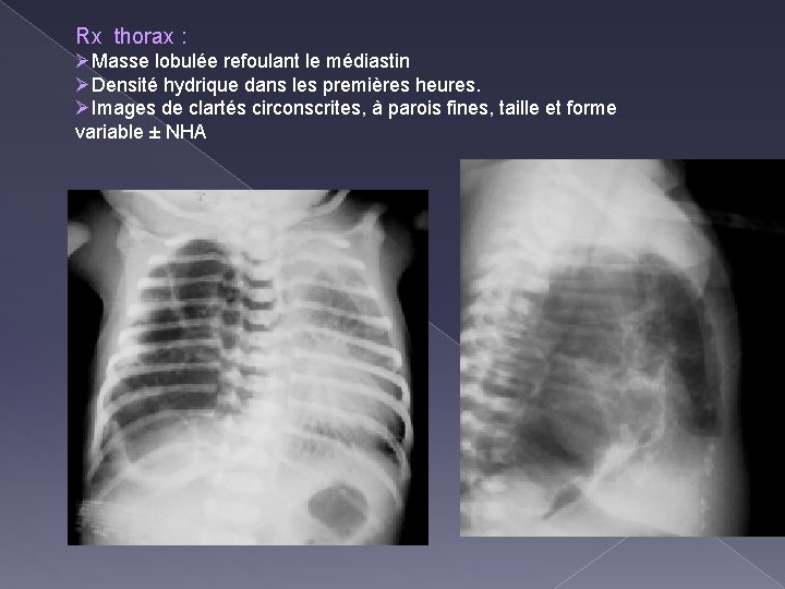 Rx thorax : ØMasse lobulée refoulant le médiastin ØDensité hydrique dans les premières heures.