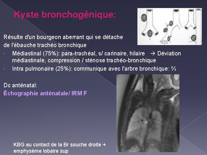 Kyste bronchogénique: Résulte d'un bourgeon aberrant qui se détache de l'ébauche trachéo bronchique •