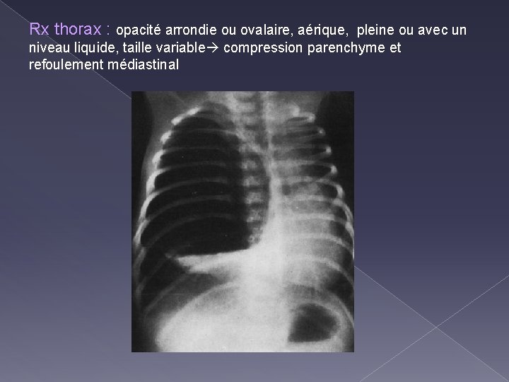 Rx thorax : opacité arrondie ou ovalaire, aérique, pleine ou avec un niveau liquide,