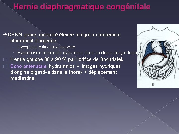 Hernie diaphragmatique congénitale DRNN grave, mortalité élevée malgré un traitement chirurgical d'urgence: • •