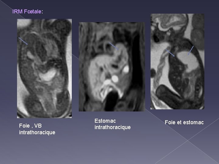 IRM Fœtale: Foie , VB intrathoracique Estomac intrathoracique Foie et estomac 