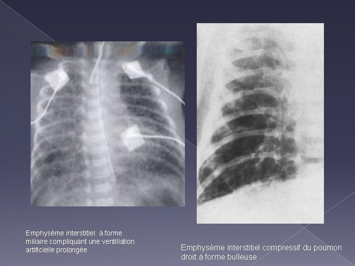 Emphysème interstitiel à forme miliaire compliquant une ventillation artificielle prolongée Emphysème interstitiel compressif du