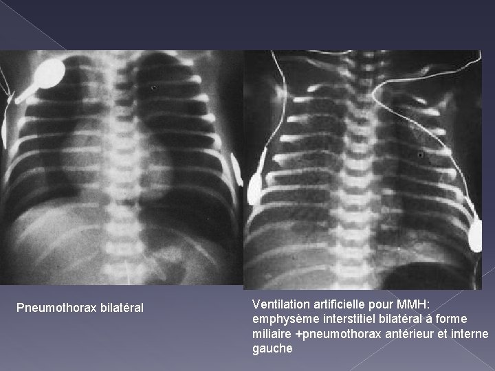 Pneumothorax bilatéral Ventilation artificielle pour MMH: emphysème interstitiel bilatéral à forme miliaire +pneumothorax antérieur