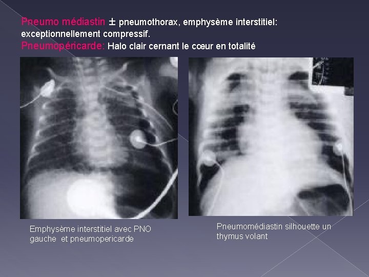 Pneumo médiastin ± pneumothorax, emphysème interstitiel: exceptionnellement compressif. Pneumopéricarde: Halo clair cernant le cœur