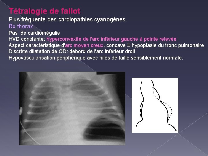 Tétralogie de fallot Plus fréquente des cardiopathies cyanogènes. Rx thorax: Pas de cardiomégalie HVD