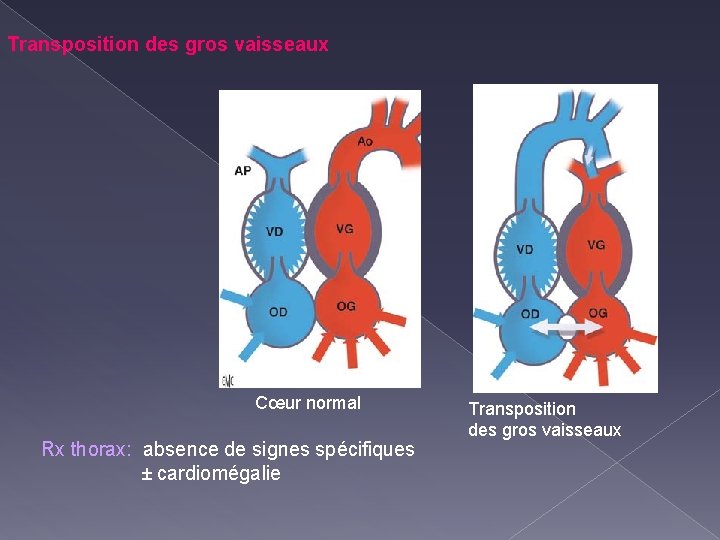 Transposition des gros vaisseaux Cœur normal Rx thorax: absence de signes spécifiques ± cardiomégalie
