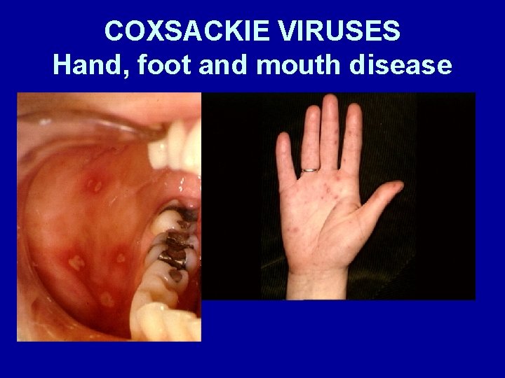 COXSACKIE VIRUSES Hand, foot and mouth disease 