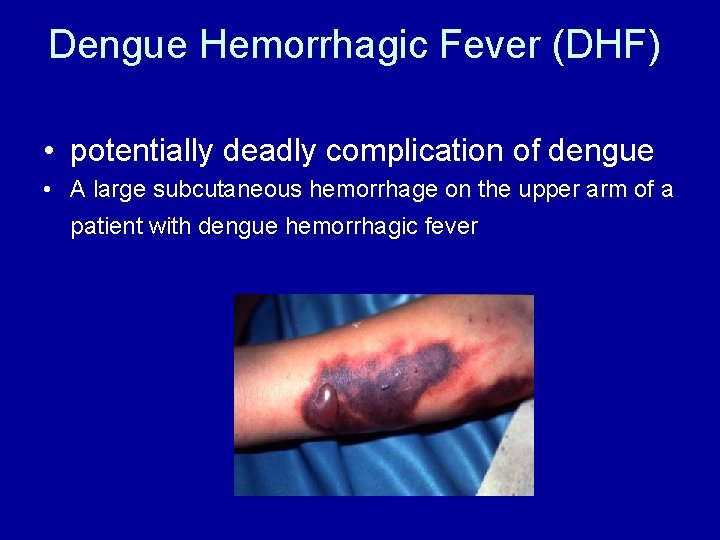 Dengue Hemorrhagic Fever (DHF) • potentially deadly complication of dengue • A large subcutaneous