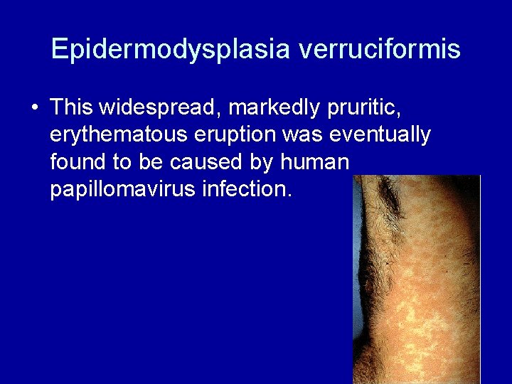 Epidermodysplasia verruciformis • This widespread, markedly pruritic, erythematous eruption was eventually found to be