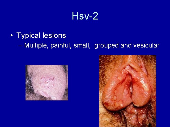 Hsv-2 • Typical lesions – Multiple, painful, small, grouped and vesicular 