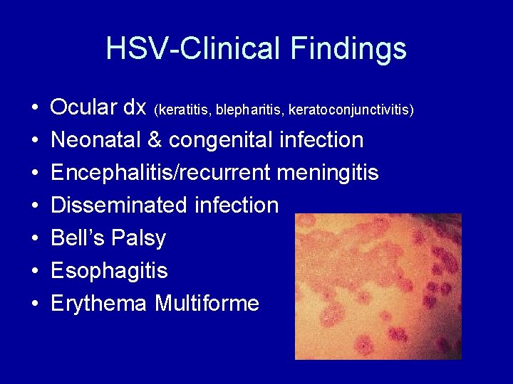 HSV-Clinical Findings • • Ocular dx (keratitis, blepharitis, keratoconjunctivitis) Neonatal & congenital infection Encephalitis/recurrent
