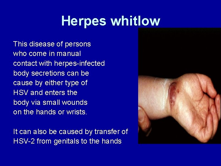 Herpes whitlow This disease of persons who come in manual contact with herpes-infected body