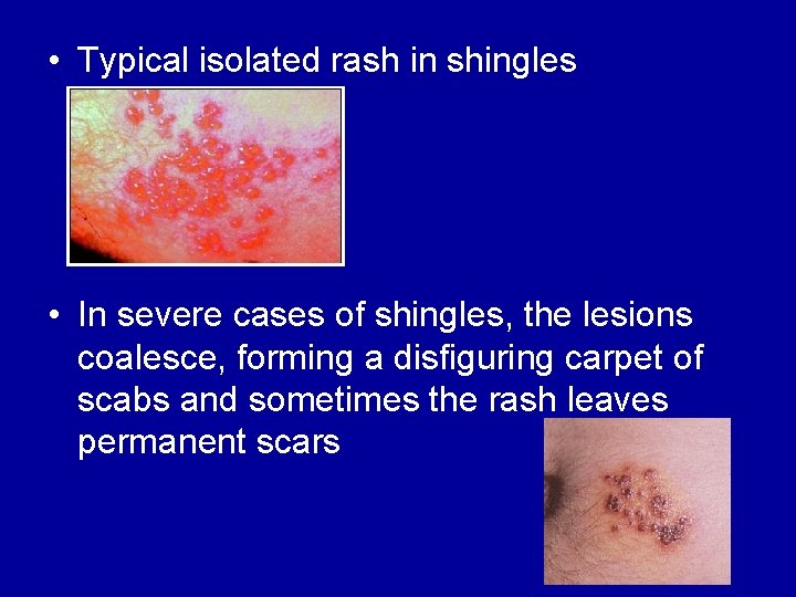  • Typical isolated rash in shingles • In severe cases of shingles, the