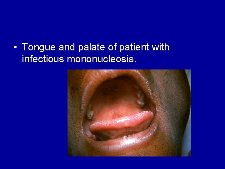  • Tongue and palate of patient with infectious mononucleosis. 