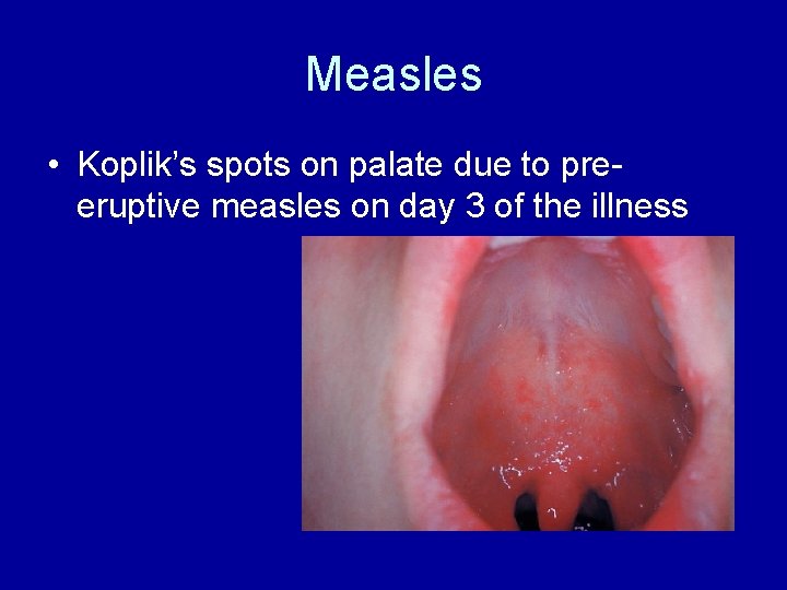 Measles • Koplik’s spots on palate due to preeruptive measles on day 3 of