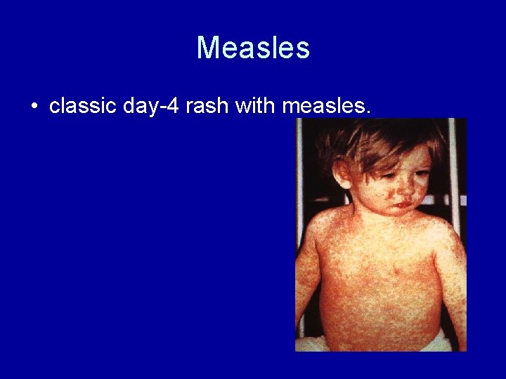 Measles • classic day-4 rash with measles. 