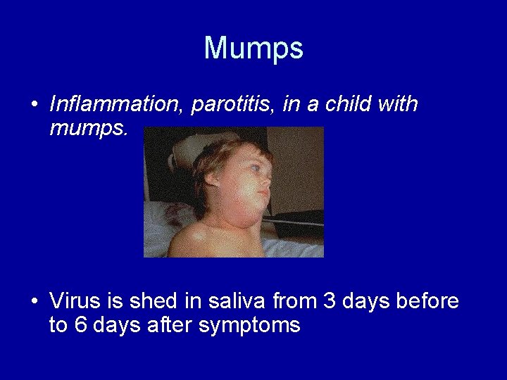 Mumps • Inflammation, parotitis, in a child with mumps. • Virus is shed in