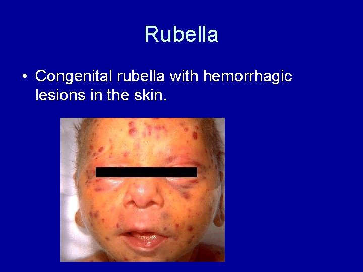 Rubella • Congenital rubella with hemorrhagic lesions in the skin. 