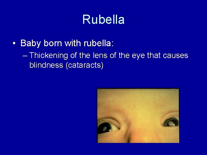 Rubella • Baby born with rubella: – Thickening of the lens of the eye