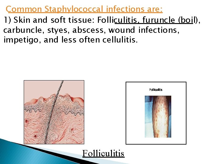 Common Staphylococcal infections are: 1) Skin and soft tissue: Folliculitis, furuncle (boil), carbuncle, styes,