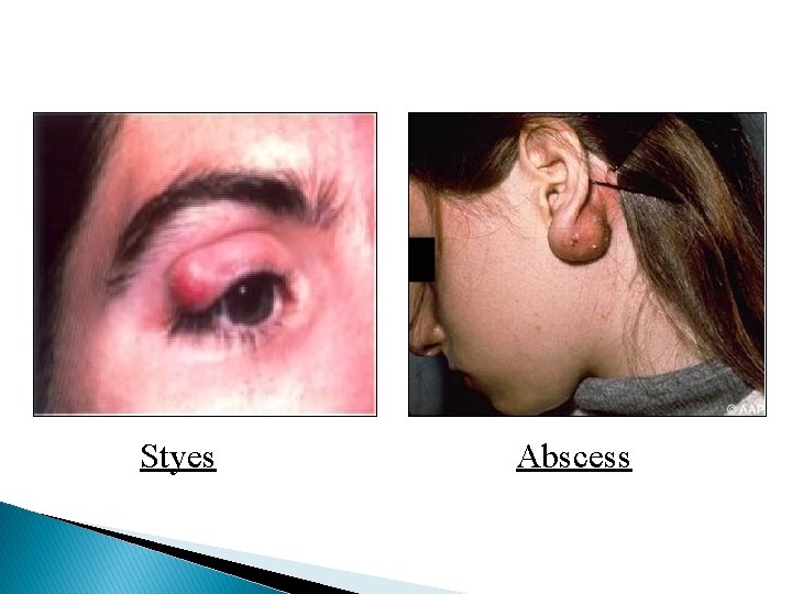 Styes Abscess 