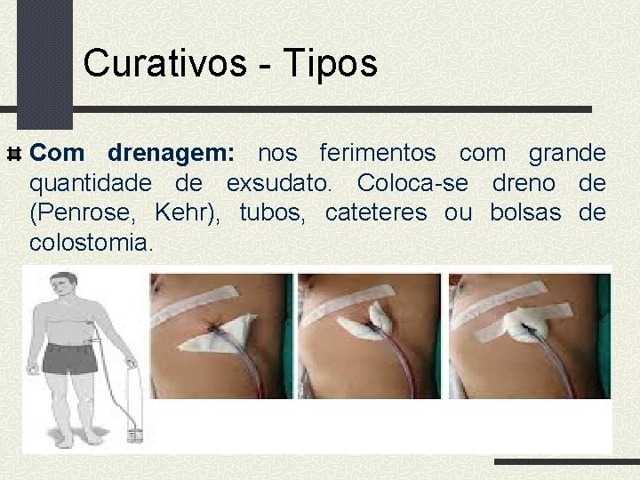 Curativos - Tipos Com drenagem: nos ferimentos com grande quantidade de exsudato. Coloca-se dreno