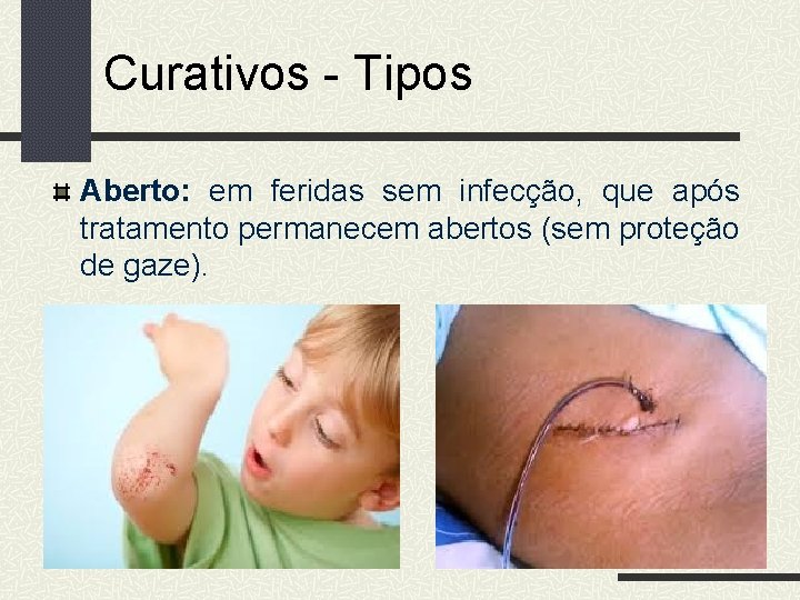 Curativos - Tipos Aberto: em feridas sem infecção, que após tratamento permanecem abertos (sem