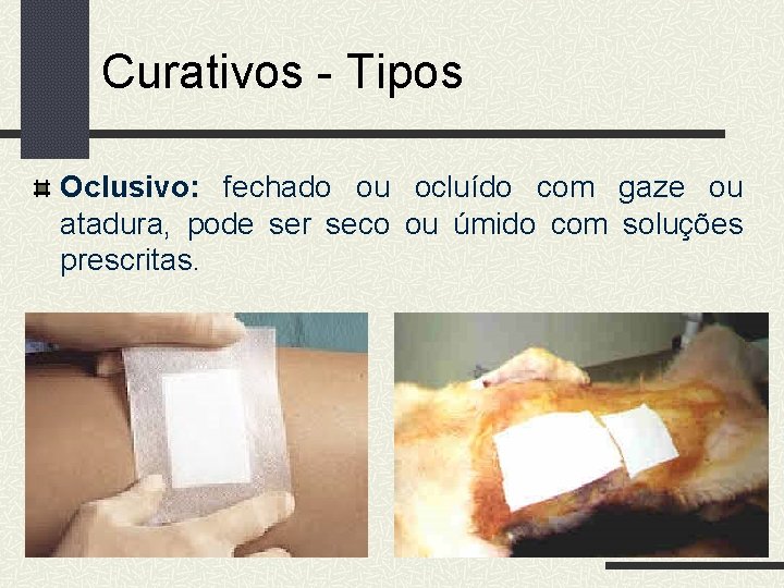 Curativos - Tipos Oclusivo: fechado ou ocluído com gaze ou atadura, pode ser seco