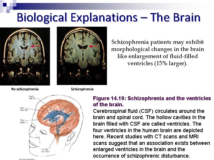 Biological Explanations – The Brain Schizophrenia patients may exhibit morphological changes in the brain
