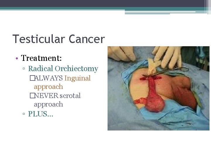 Testicular Cancer • Treatment: ▫ Radical Orchiectomy �ALWAYS Inguinal approach �NEVER scrotal approach ▫