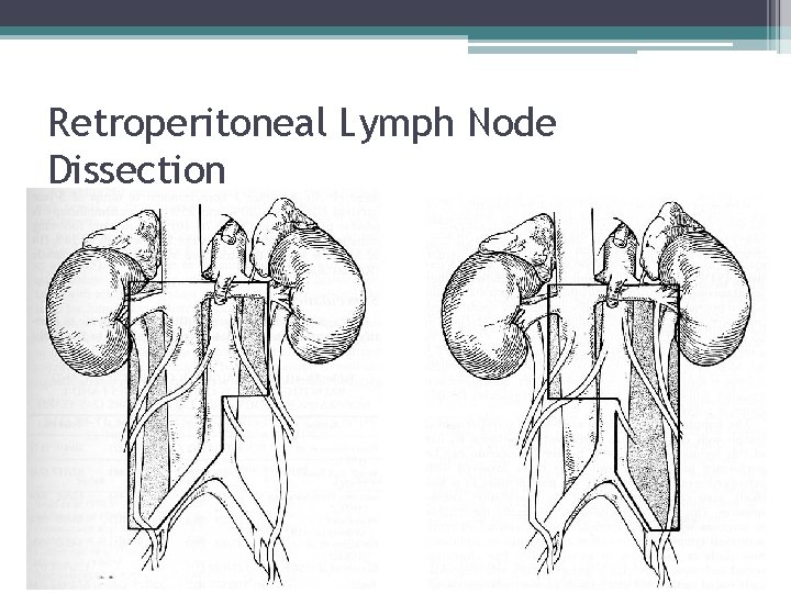 Retroperitoneal Lymph Node Dissection 