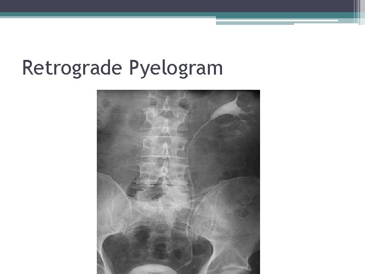Retrograde Pyelogram 