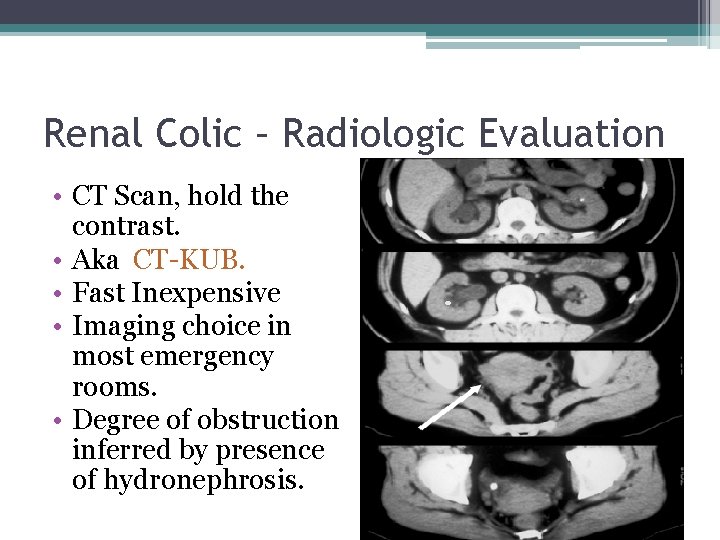 Renal Colic – Radiologic Evaluation • CT Scan, hold the contrast. • Aka CT-KUB.