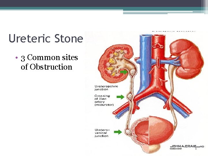 Ureteric Stone • 3 Common sites of Obstruction 