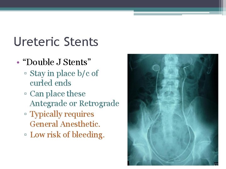 Ureteric Stents • “Double J Stents” ▫ Stay in place b/c of curled ends